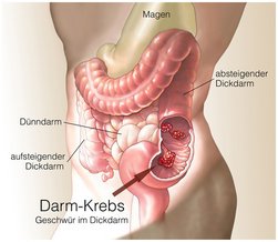 Darmkrebsmonat März